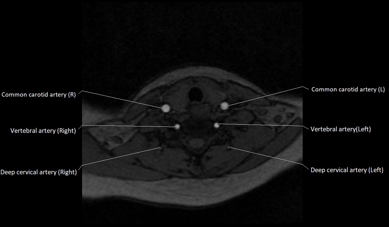 Carotid artery anatomy axial 3T image 51.jpg